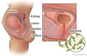 Pregnancy and UTIS